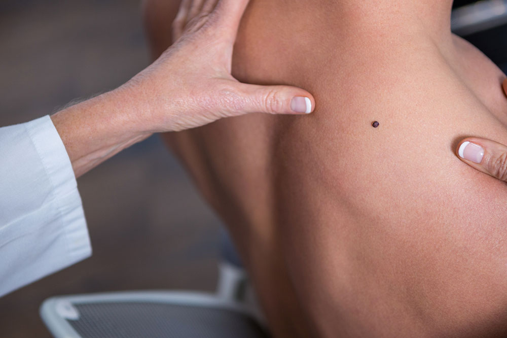Melanoma – Symptoms and Natural Remedies