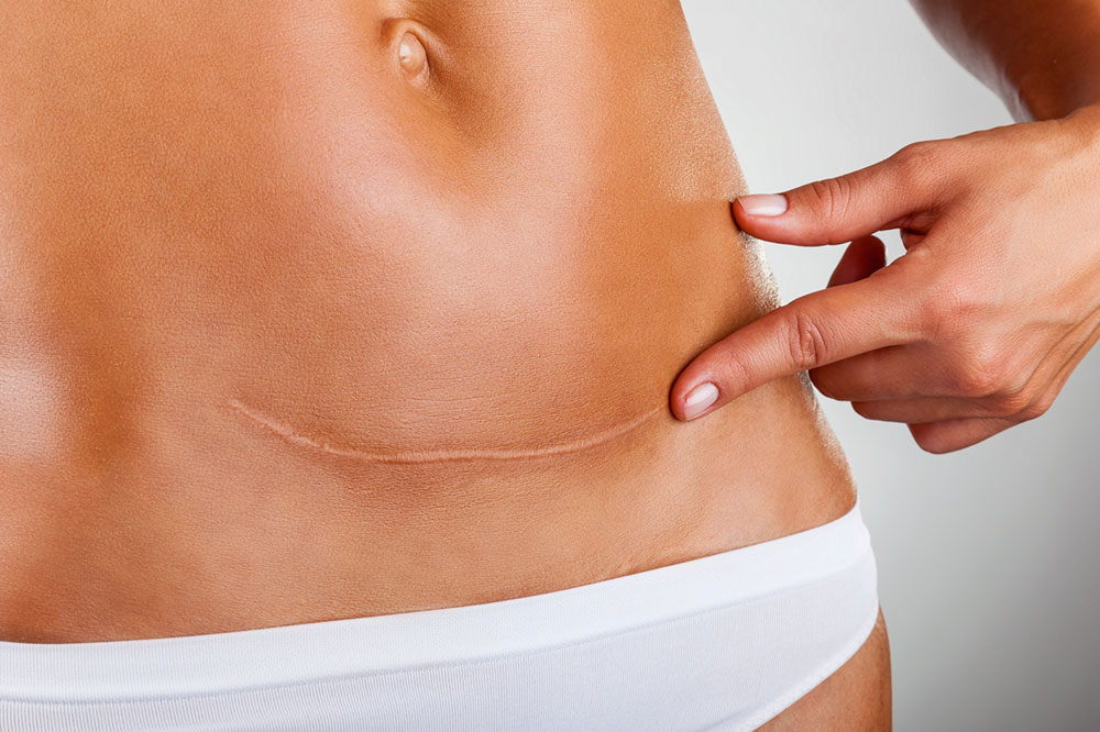 Causes and Treatment Options for Ovarian Cancer