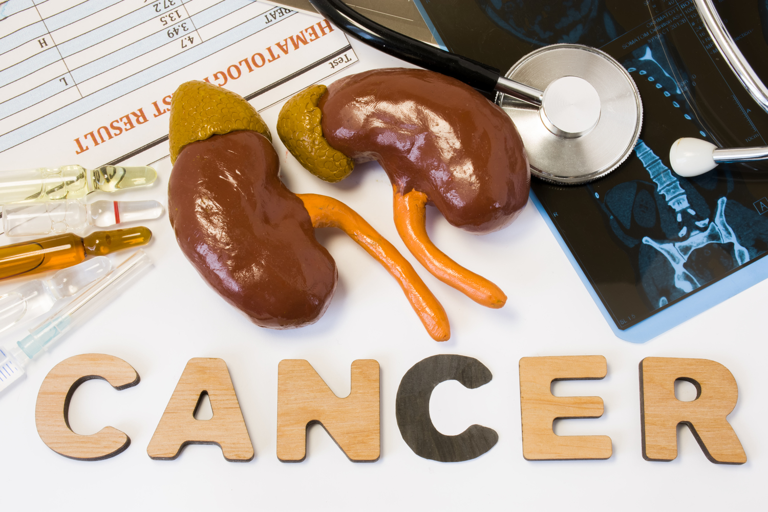 Common Causes of Kidney Cancer